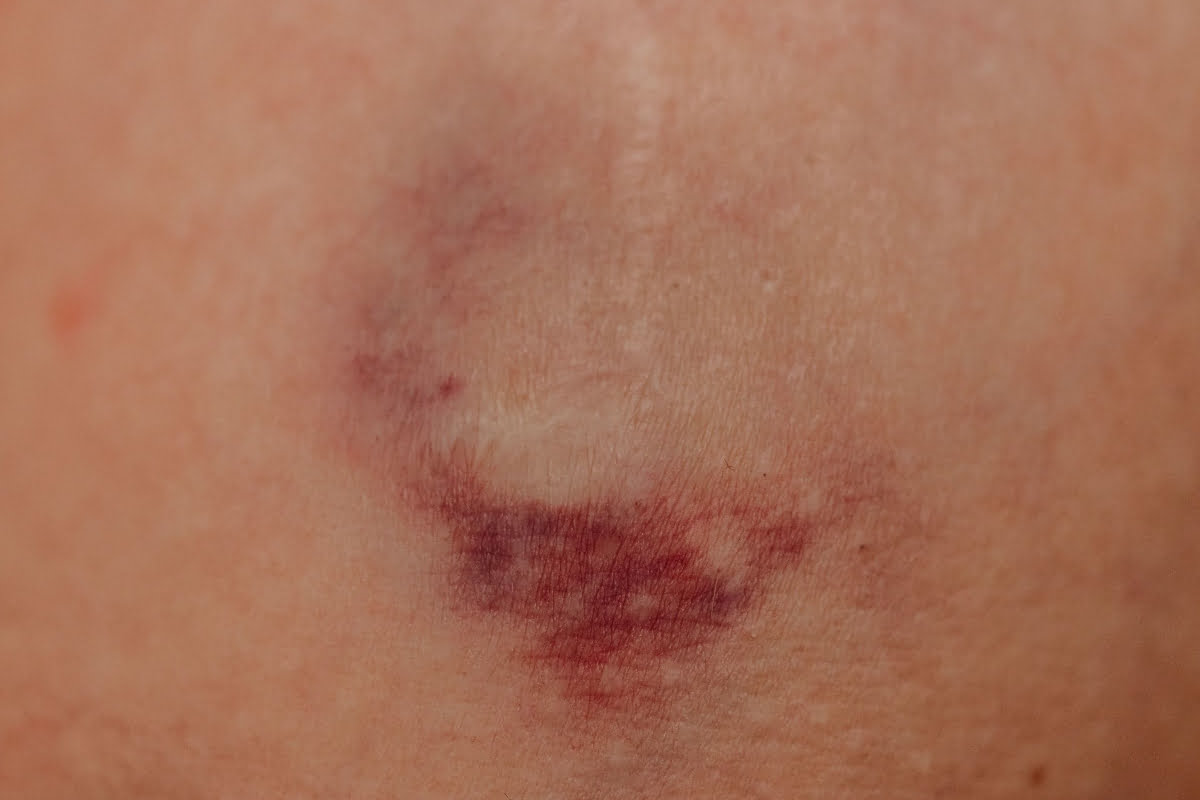 What vitamins should I take if I bruise easily?